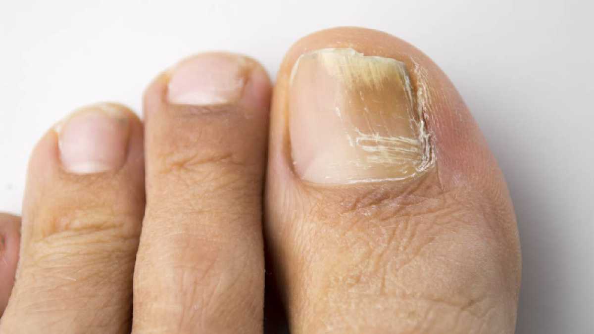Nail Fungus Produces A White, Brown, Or Yellow Discoloration;  It Can Thicken Or Even Break Them.  Photo: Getty Images.
