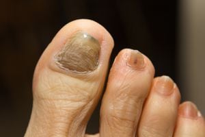 Ridged, thick and discolored toenail with fungus, a side effect caused by chemotherapy drugs administered during cancer treatments.