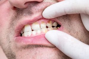 El sarro dental puede ocasionar diversas afecciones no solo en la boca.