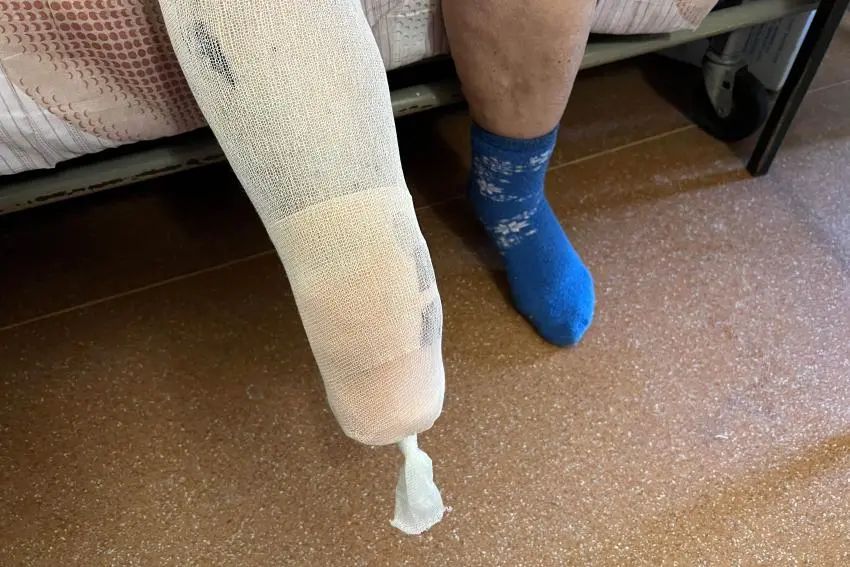 Residente que perdió el extremo inferior de la pierna tras posarse sobre una mina antipersonal PFM cerca de su vivienda en Ucrania.