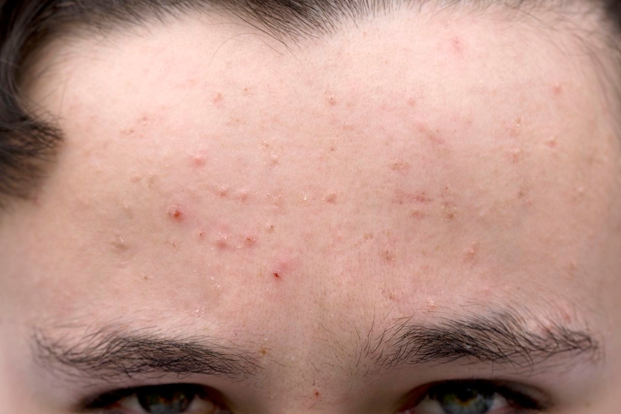 El acné es un trastorno cutáneo.