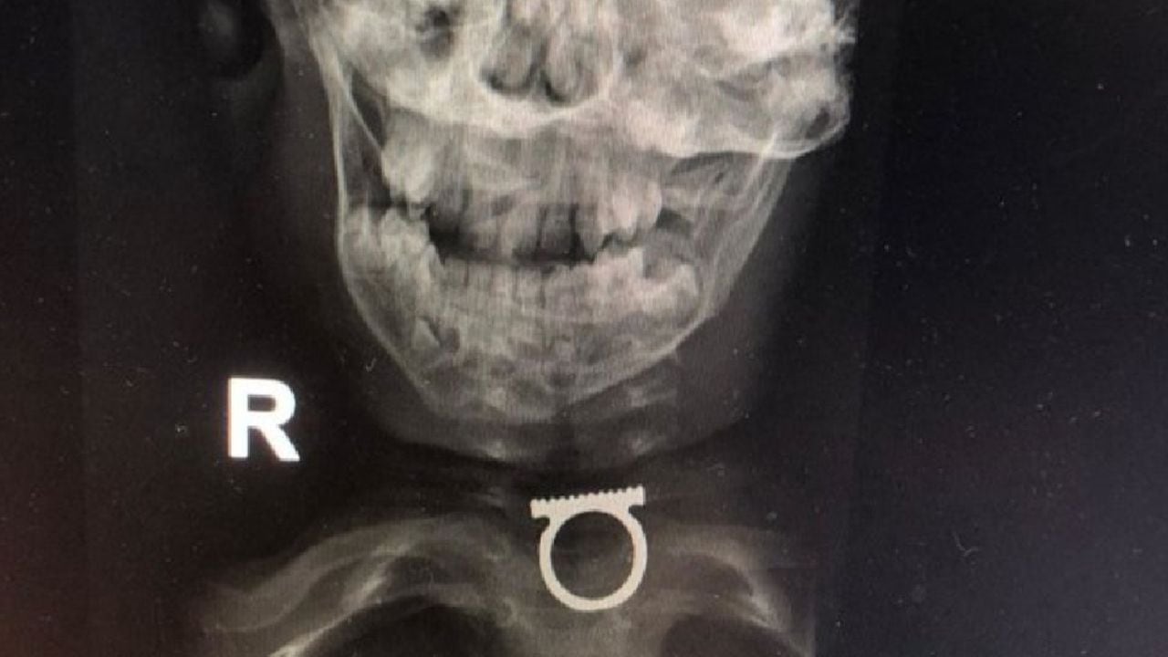 Médicos lograron extraer sin complicaciones el anillo incrustado en la garganta del menor.