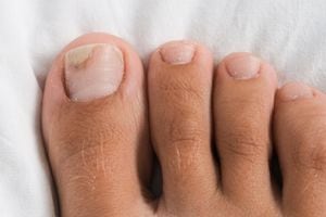 Los hongos en uñas de los pies pueden aliviarse con remedios caseros.