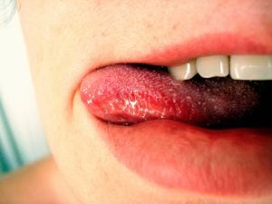 La mayoría de veces cuando se presentan manchas negras en la lengua, son inofensivas.