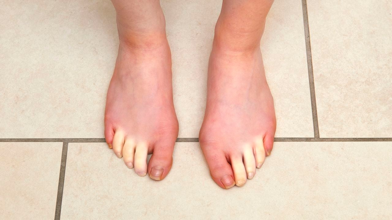 Frío en los pies y en las manos puede ser un signo de mala circulación.