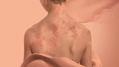 La piel de mariposa es una extraña enfermedad que afecta la piel de los niños.