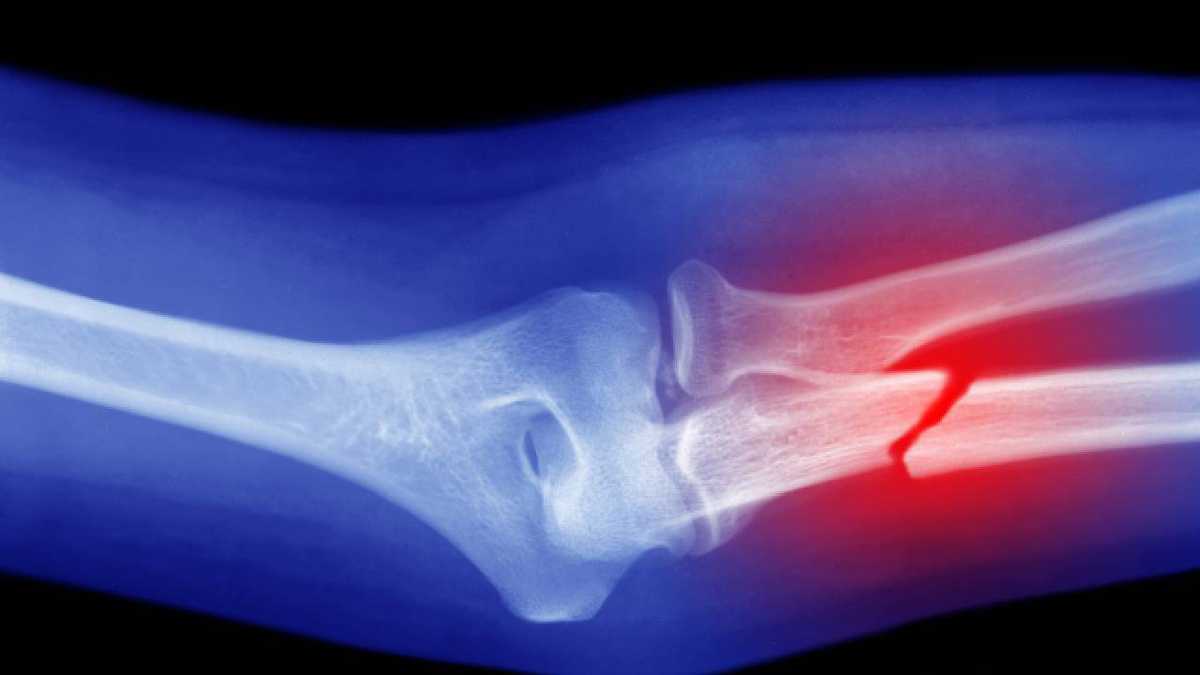 Experts advise being careful with products rich in oxalates, which can make it difficult for the bones to absorb calcium.  Photo: Getty images.