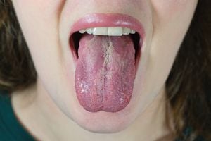 La lengua blanca está asociada con diferentes enfermedades.
