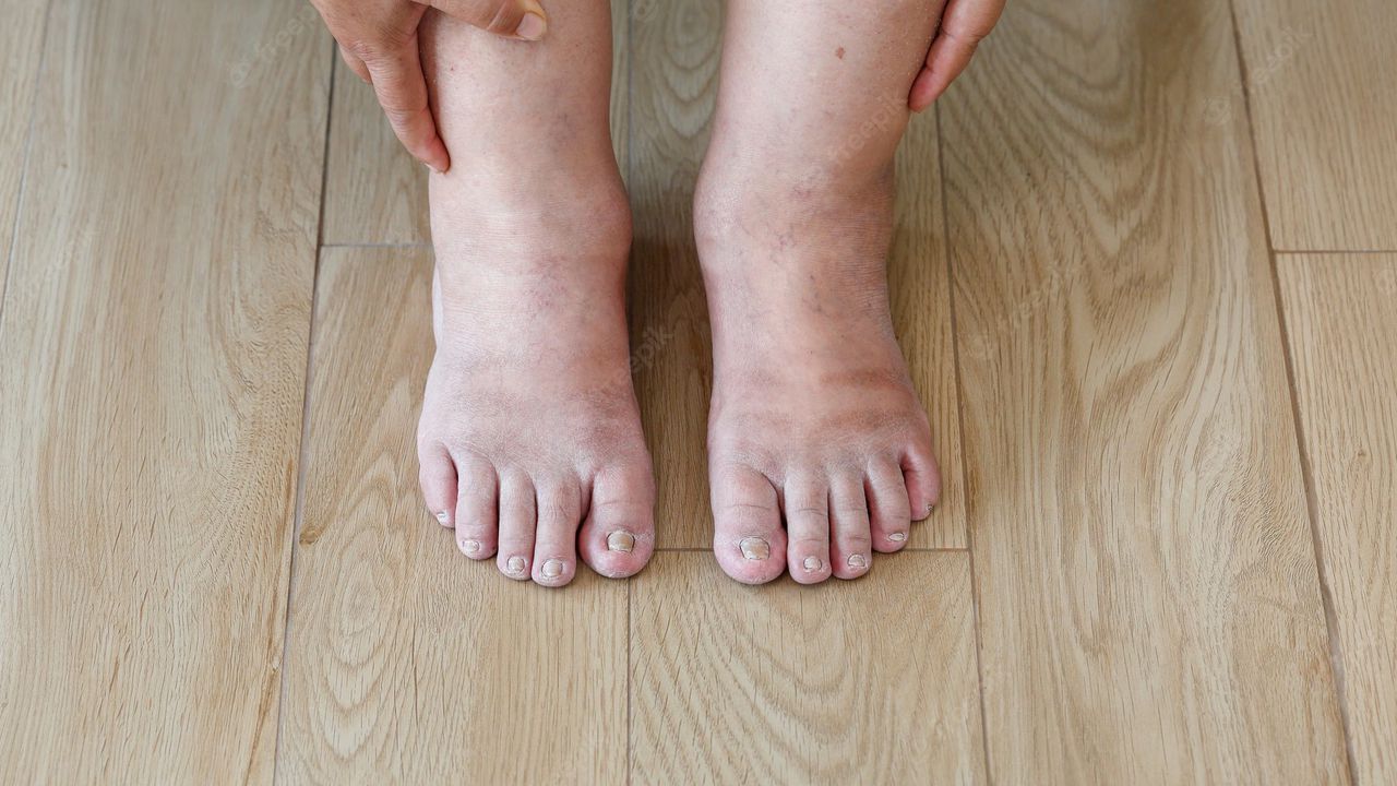 La hinchazón en piernas y pies afecta al tratamiento de la hipotensión. Por lo que los médicos recomiendan usar medias especiales para que la sangre circula y se regule.