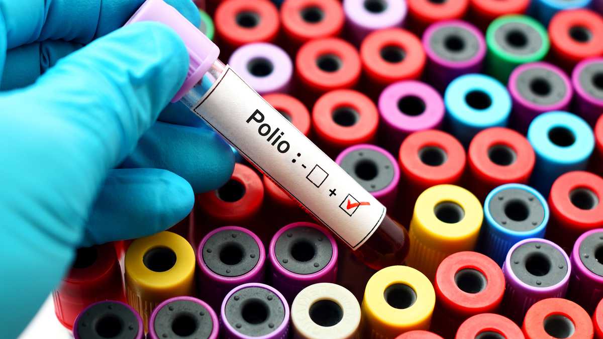 Positivo para poliomielitis - Imagen de referencia