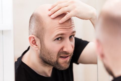 La caída del cabello se asocia con un factor hereditario.