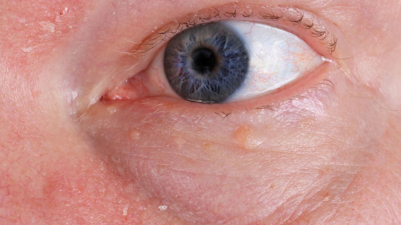 Herpes en los ojos