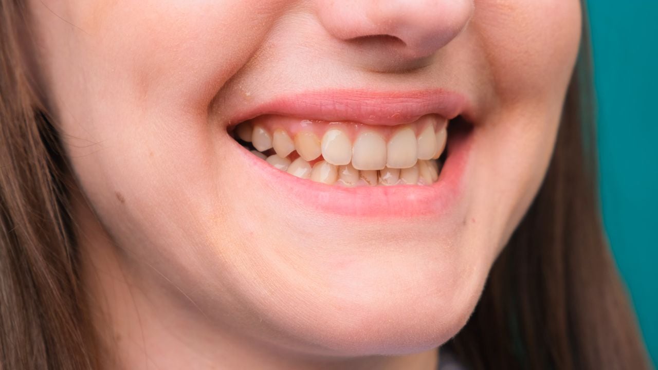 Yellow teeth can be caused by a variety of factors.