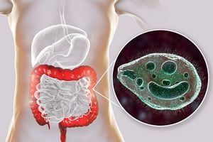 Balantidium coli protozoan in large intestine, 3D illustration. Ciliated intestinal parasite that causes balantidiasis