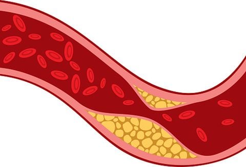 El colesterol LDL se incrementa por un plan de alimentación rico en grasa.