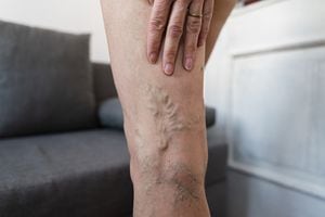 Close-up of varicose veins on woman leg