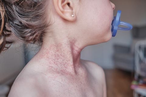 La dermatitis atópica se presenta mucho en los niños menores de 6 años.