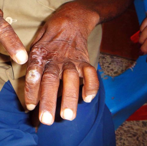 Actualmente hay 37 casos de lepra en el departamento que están bajo seguimientos por las autoridades en salud.