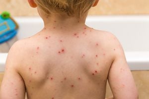 La varicela normalmente es menos fuerte en los niños que en los adultos.