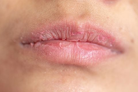 Los labios agrietadaos pueden ser una consecuencia de la alta exposición al sol.