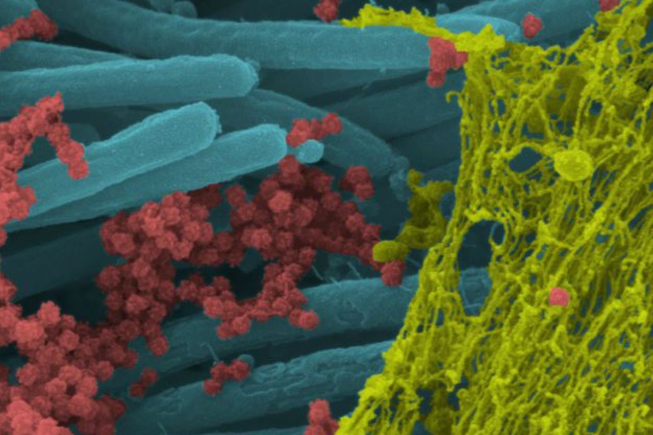 Esta imagen fue re-coloreada por el estudiante de medicina de la UNC Cameron Morrison, en la que muestra células ciliadas infectadas con hebras de moco (amarillo) adheridas a las puntas de los cilios (azul). Los cilios son estructuras similares a pelos en la superficie de las células epiteliales de las vías respiratorias que transportan moco (y virus atrapados) desde el pulmón.