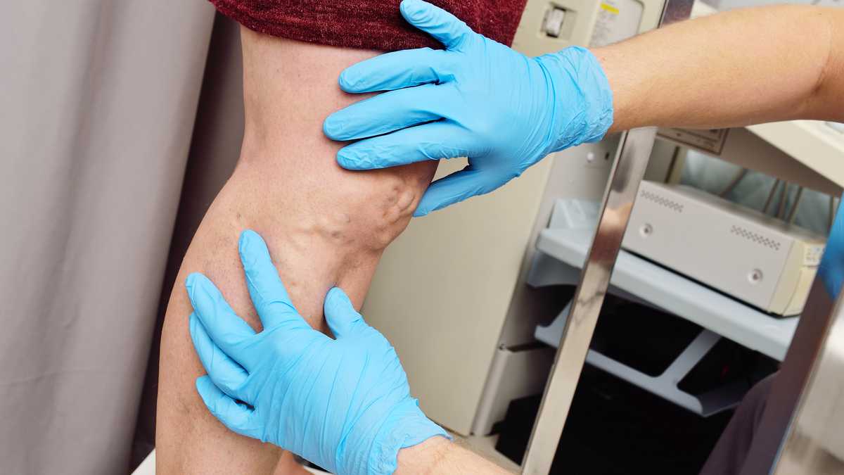 a phlebologist or vascular surgeon examines the varicose veins of the lower extremities of a patient in a modern dermatological clinic. Phlebology.