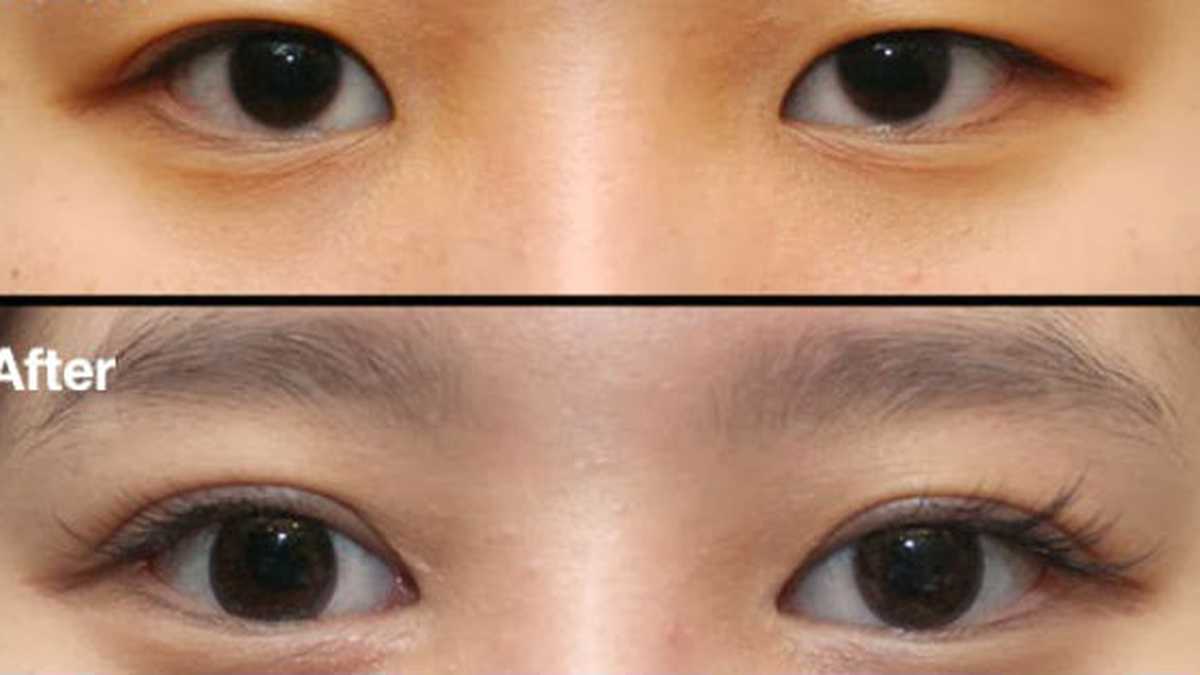 La blefaroplastia asiática, también llamada 'cirugía de párpados dobles', hace que los ojos se vean más occidentales.