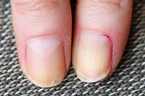Nail fungus can cause yellow color.