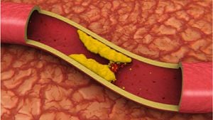 Los niveles altos del 'colesterol malo' (LDL) incrementa el riesgo de padecer enfermedades cardíacas, diabetes o renales. Foto: Getty Images.