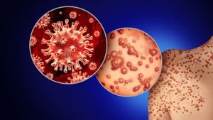 Son más de 5000 los casos de contagio registrados en todo el mundo. Foto: Getty Images.