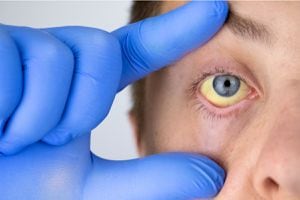 La coloración amarilla en ojos no es habitual. Esta situación es conocida como ictericia y es una clara señal de que existe algún problema en el funcionamiento del hígado.
