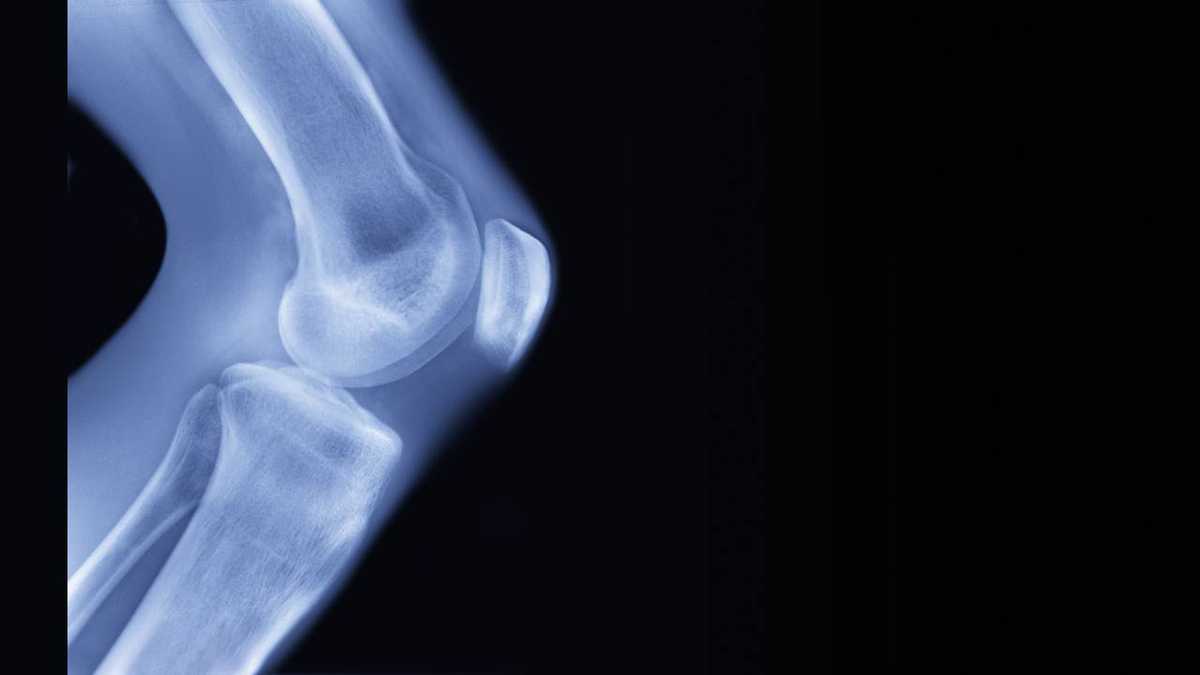 The instability of the knee originates when one of its supports fails, preventing the bones from being held in the proper position.  Photo: Getty Images.