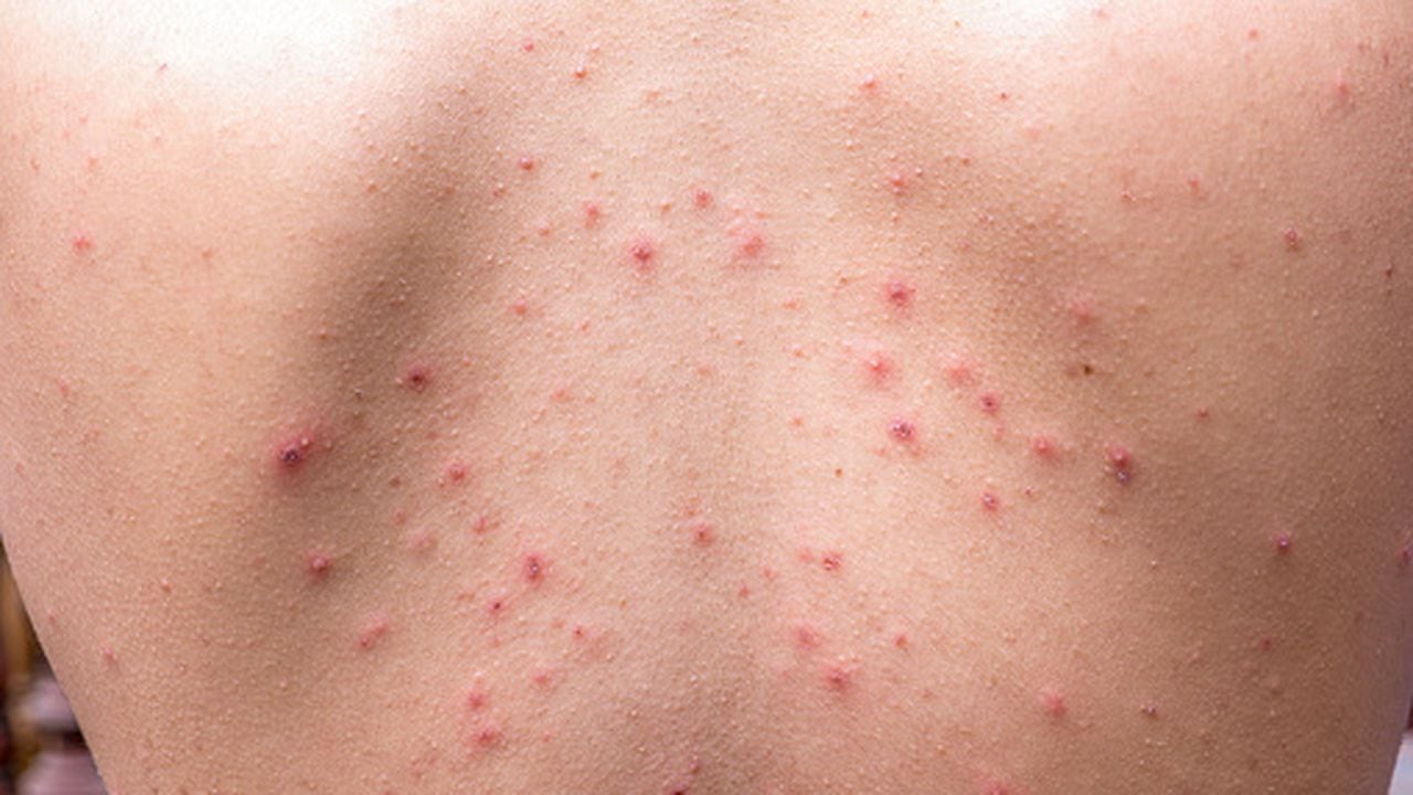 Los adultos también pueden sufrir de acné.