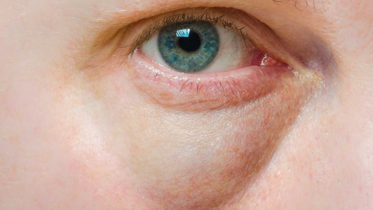 Bolsas en los ojos: Estos son los mejores remedios caseros para reducirlas