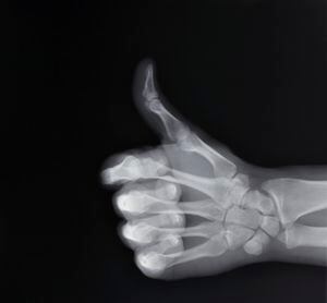 X-ray of hand making thumbs up gesture