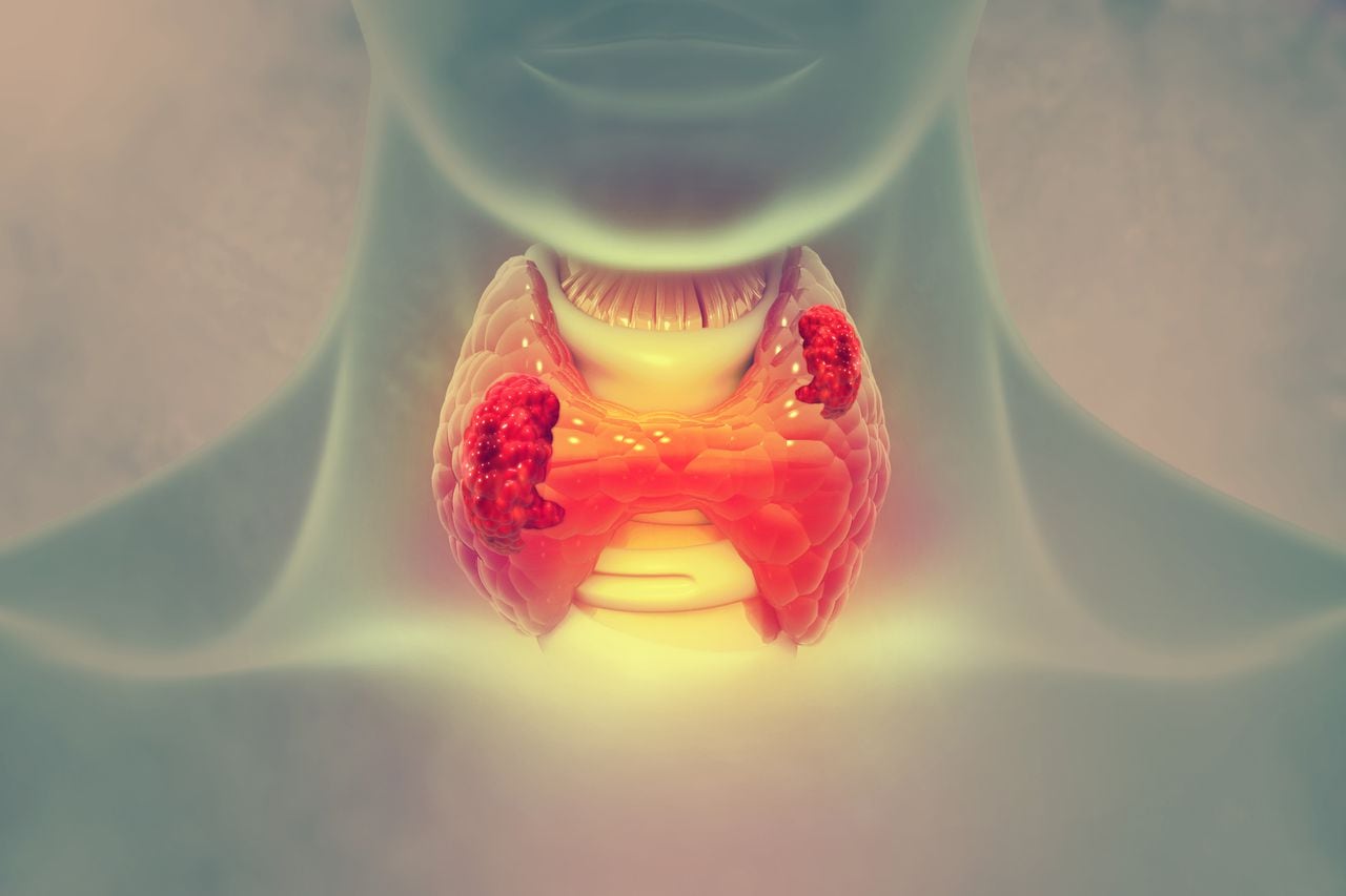 Cáncer de tiroides - Imagen de referencia