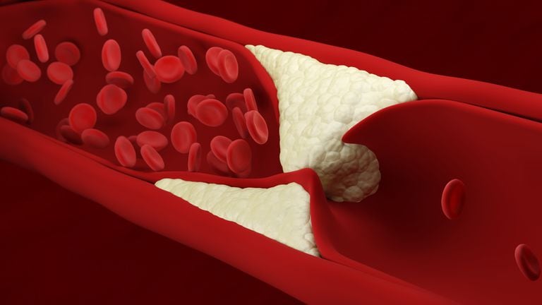 El colesterol alto puede traer graves afectaciones para el cuerpo humano.