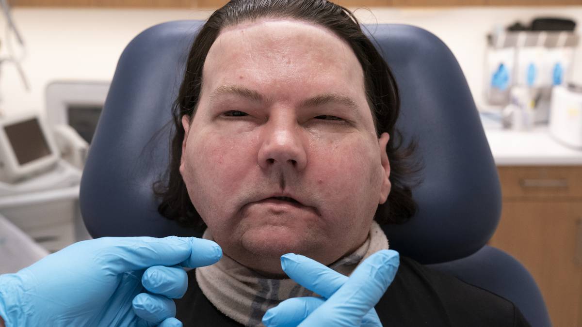 Resultado de imagen para Hombre recibe trasplante de cara y manos