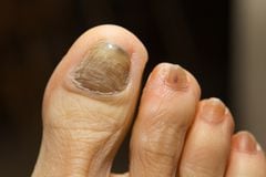 Las uñas gruesas pueden formarse por algunas enfermedades.