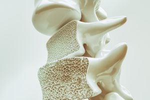 La osteoporosis es una enfemredad que se puede prevenir con una dieta balanceada.
