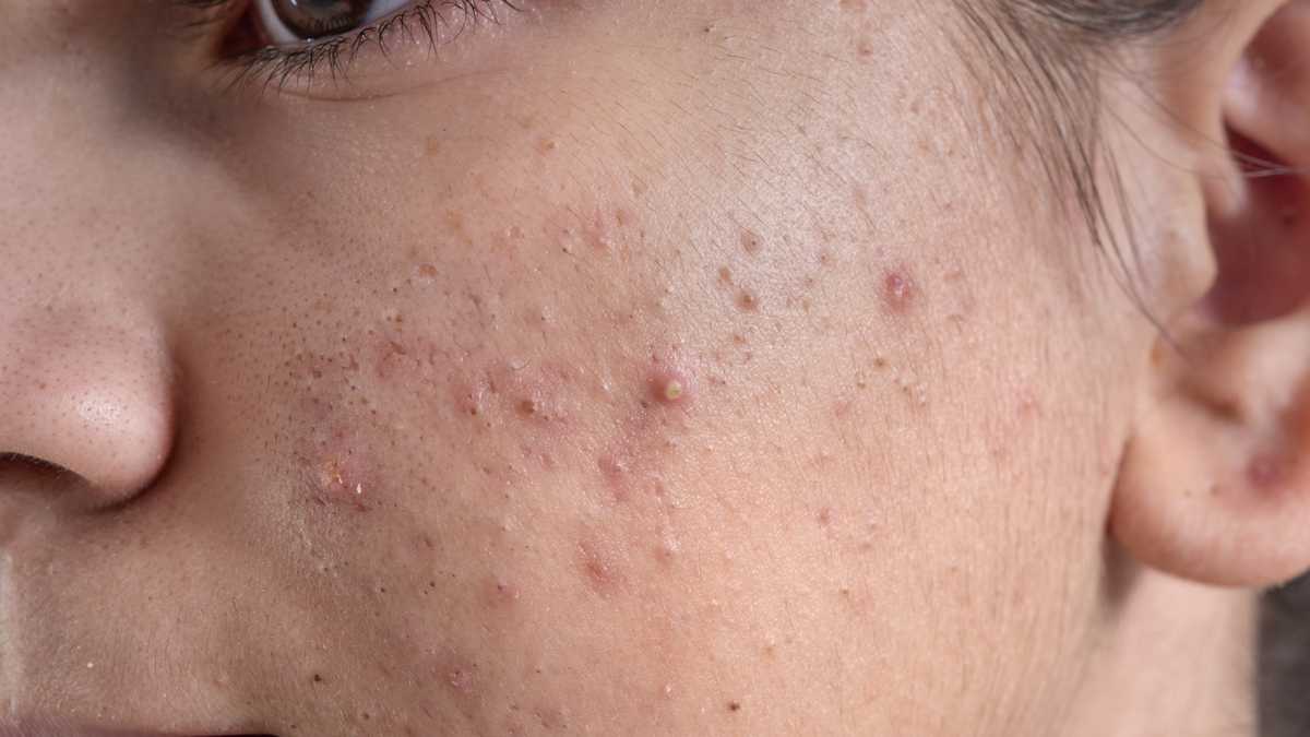 Acné: Síntomas, causas y mitos sobre esta afección cutánea en la piel