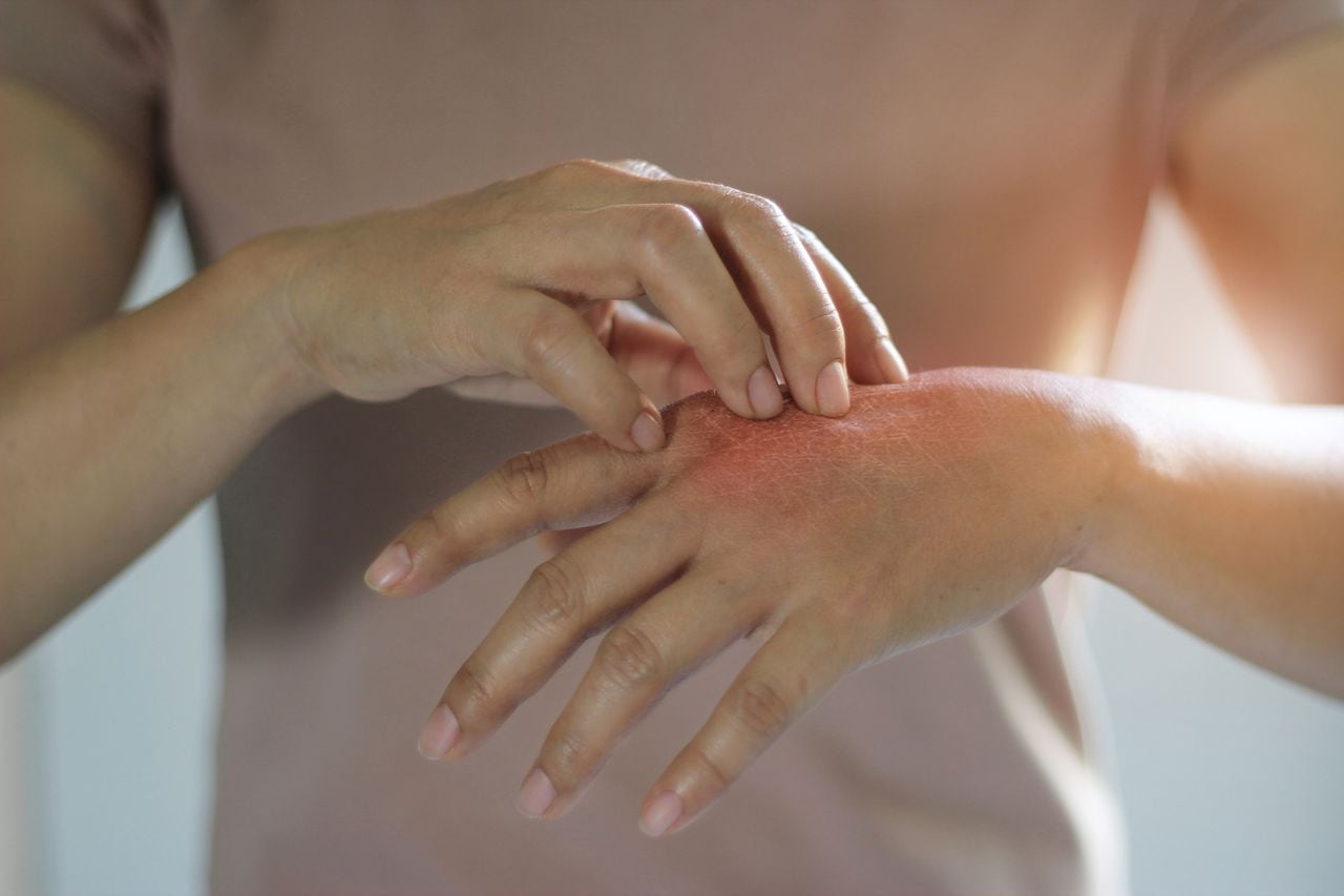 Aunque poco común, las mordeduras de cucarachas pueden causar irritación y picazón en la piel afectada.