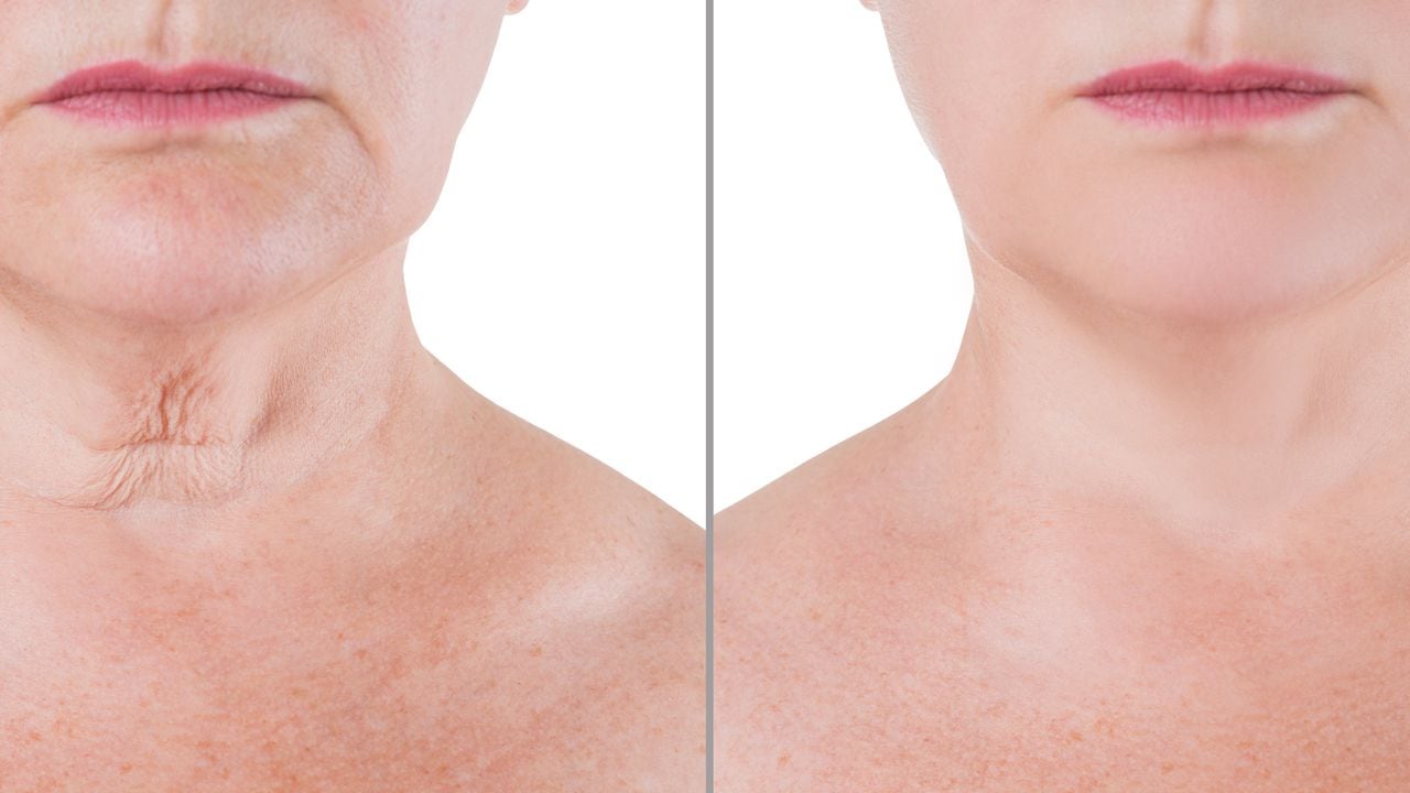 Arrugas en el cuello y pecho: remedios naturales para reducirlas