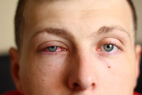 Conjuntivitis: Estos son los remedios caseros para curar esta infección en los ojos