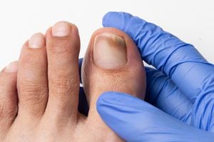 Close-up image of the doctor who controls the left toe that suffers a fungus nail