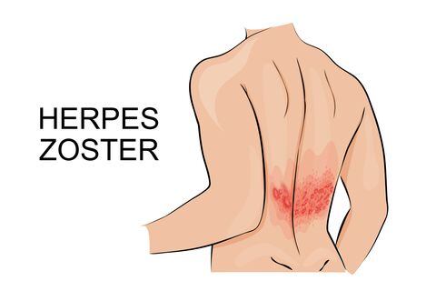 Infección por herpes zóster - Imagen de referencia