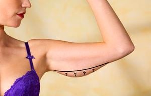 Plastic surgery marks to remove excess skin/fat on  woman's flabby arms.