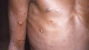 Esta imagen de 1997 proporcionada por los Centros para el Control y la Prevención de Enfermedades muestra el brazo derecho y el torso de una persona afectada con viruela del mono. Foto: CDC via AP.