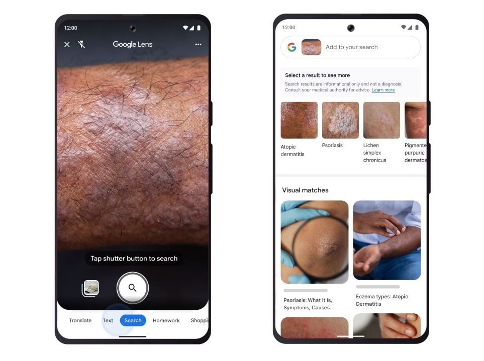 Google Lens ayudaría a detectar enfermedades en la piel.