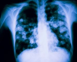 edema pulmonar